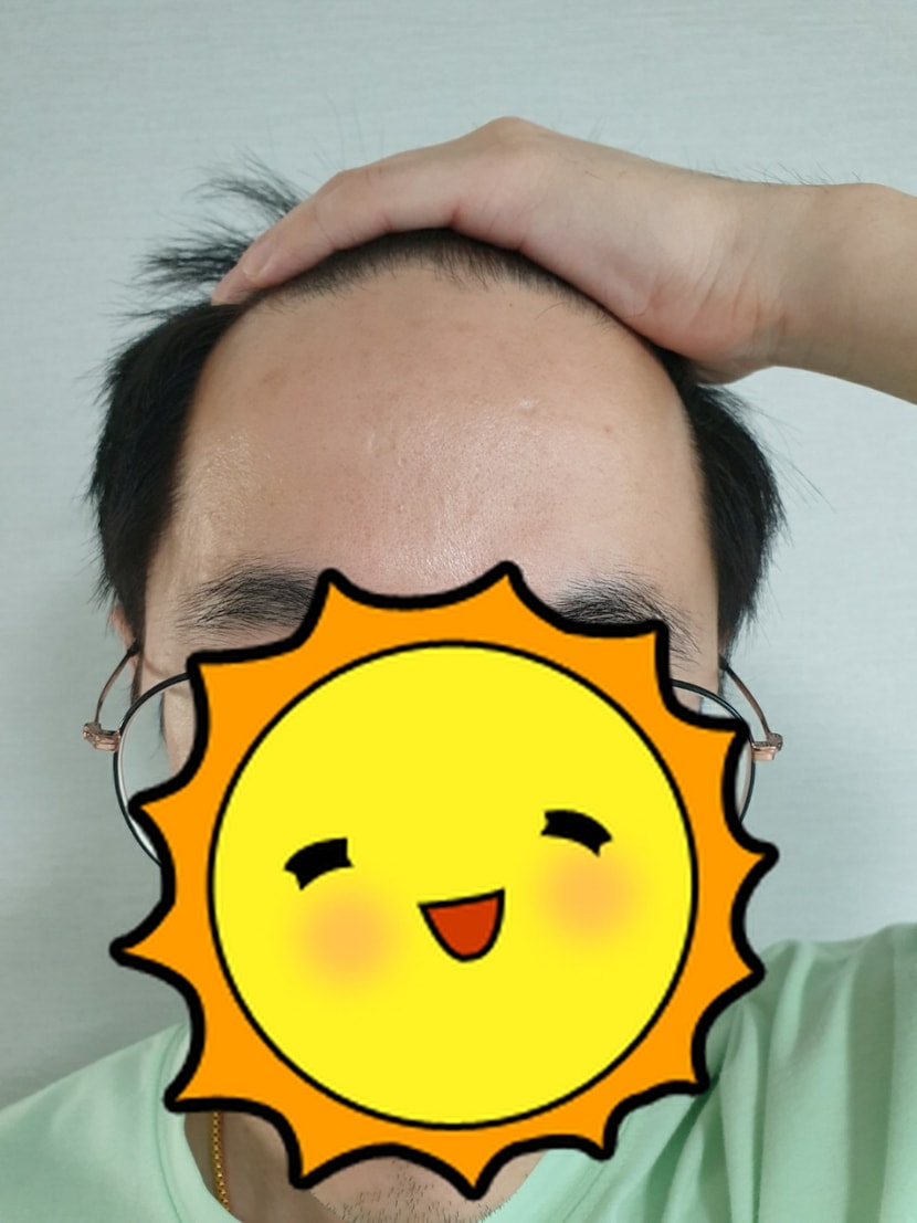 수술 전