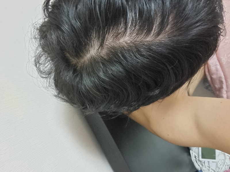 미녹시딜+피나스테리드 8개월차..