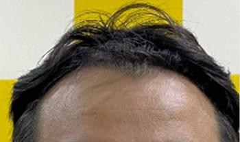 모발이식 전