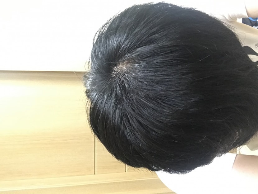 정수리도 굵기가 얆아짐
