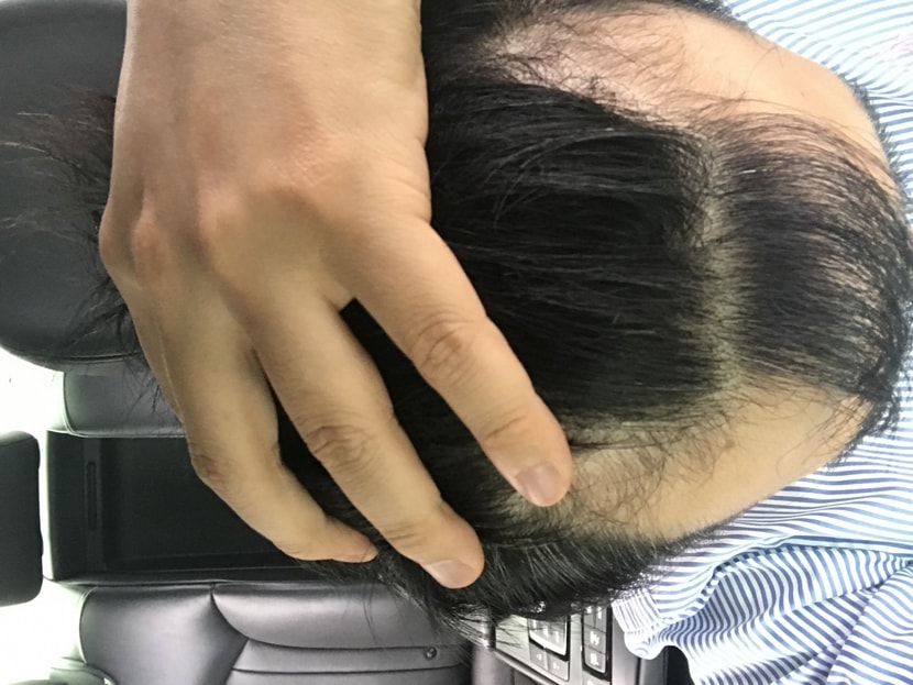 현재 빠진 M자 부분