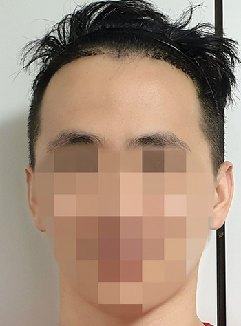 수술 7일차