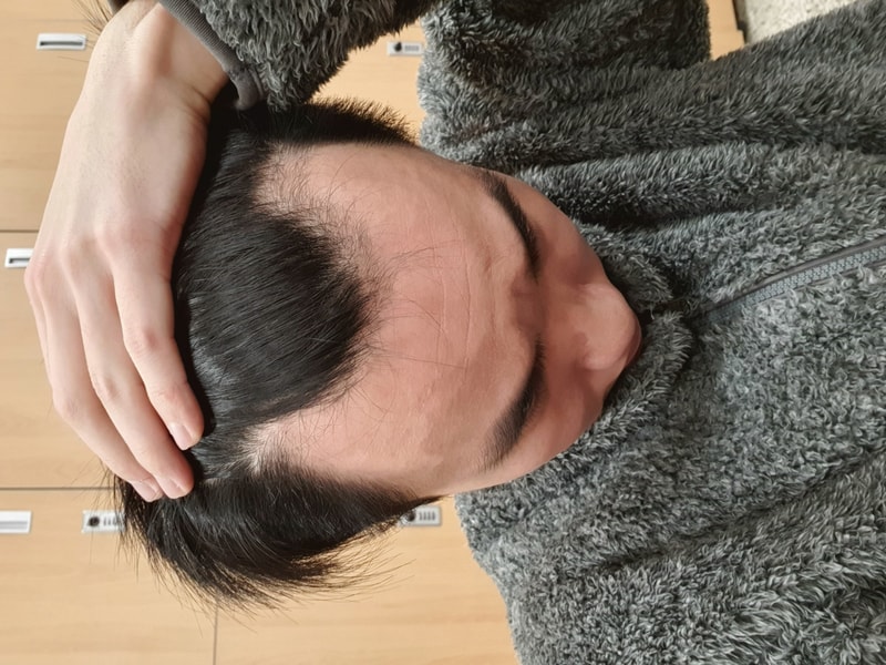 프로페시아+모발이식 8개월차 큰변화