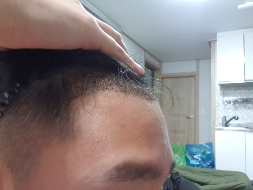 수술 후 머리