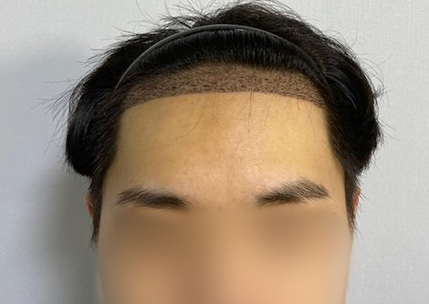 수술 후