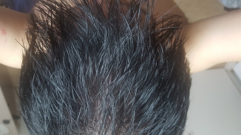 정수리부터 가운데까지 전범위확산  더군다나m자까지 깊어짐