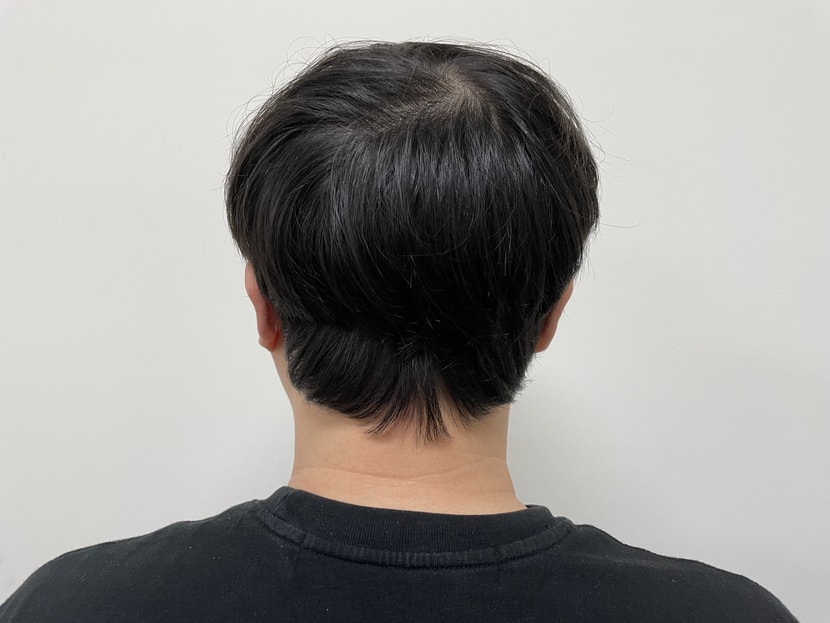 수술 후 뒷머리