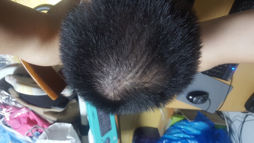 19.7.2약복용한달경과