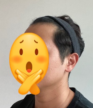 수술 전 사진들이에요