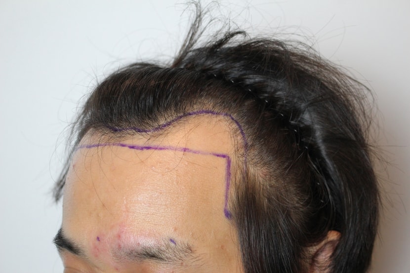 모발이식 전
