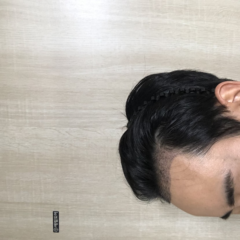 이식 후