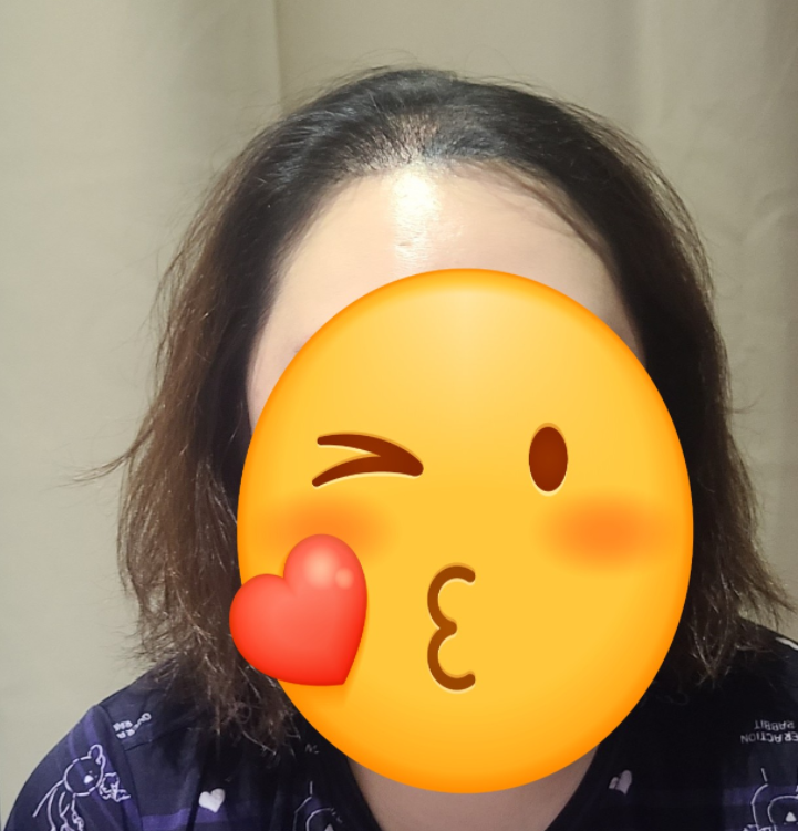 수술 후 사진 2