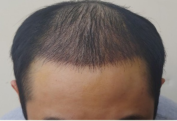 수술하고 7일 됐을 때 머리에요