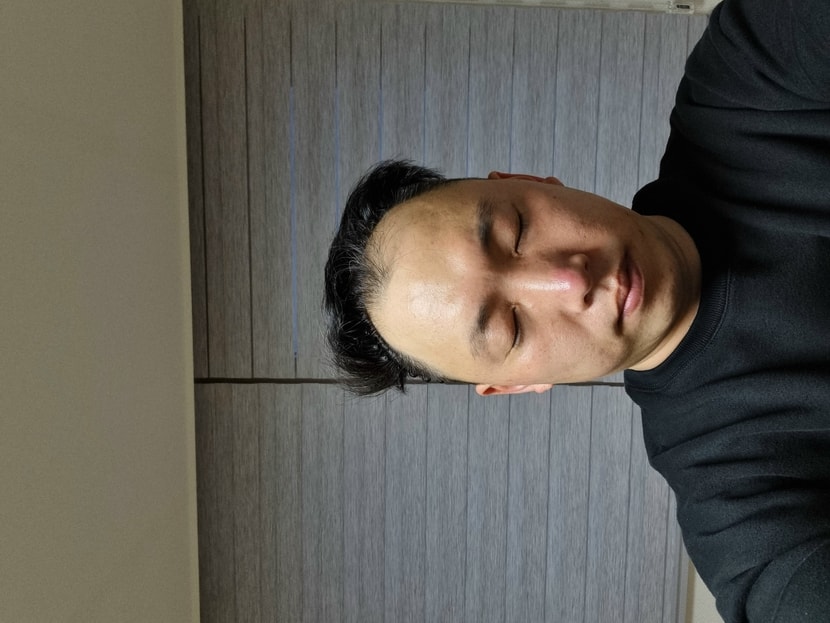 수술 전 머리에요