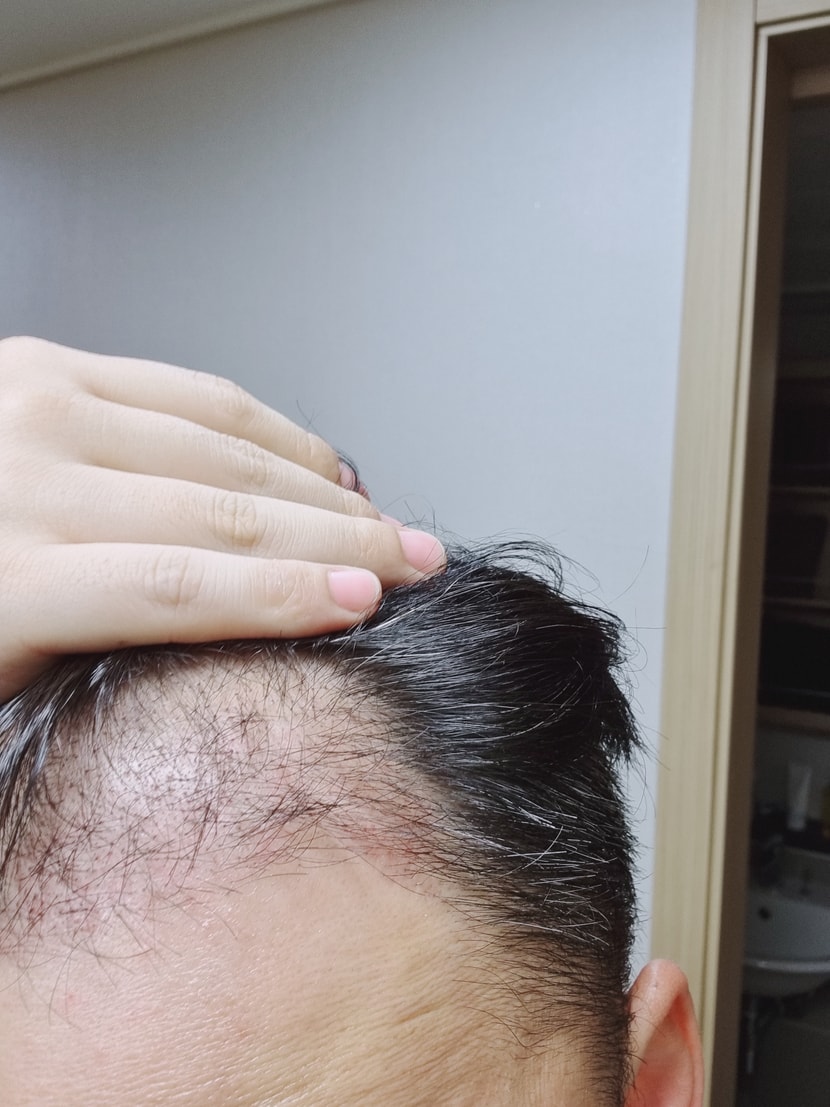 수술 후 앞머리