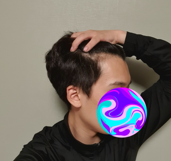 이식 전