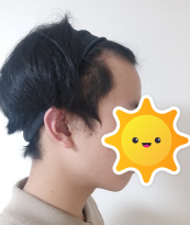 수술 전 머리입니다