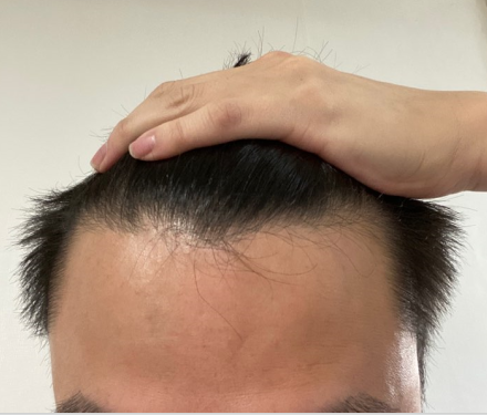 모발이식 받기 전 사진입니다