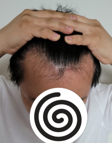 非切开毛发移植两周后期。