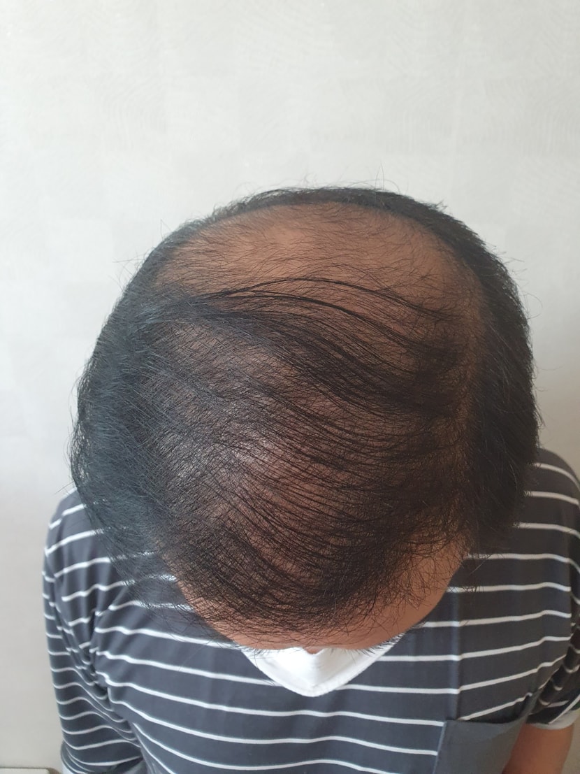 수술 하기 전 정수리네요