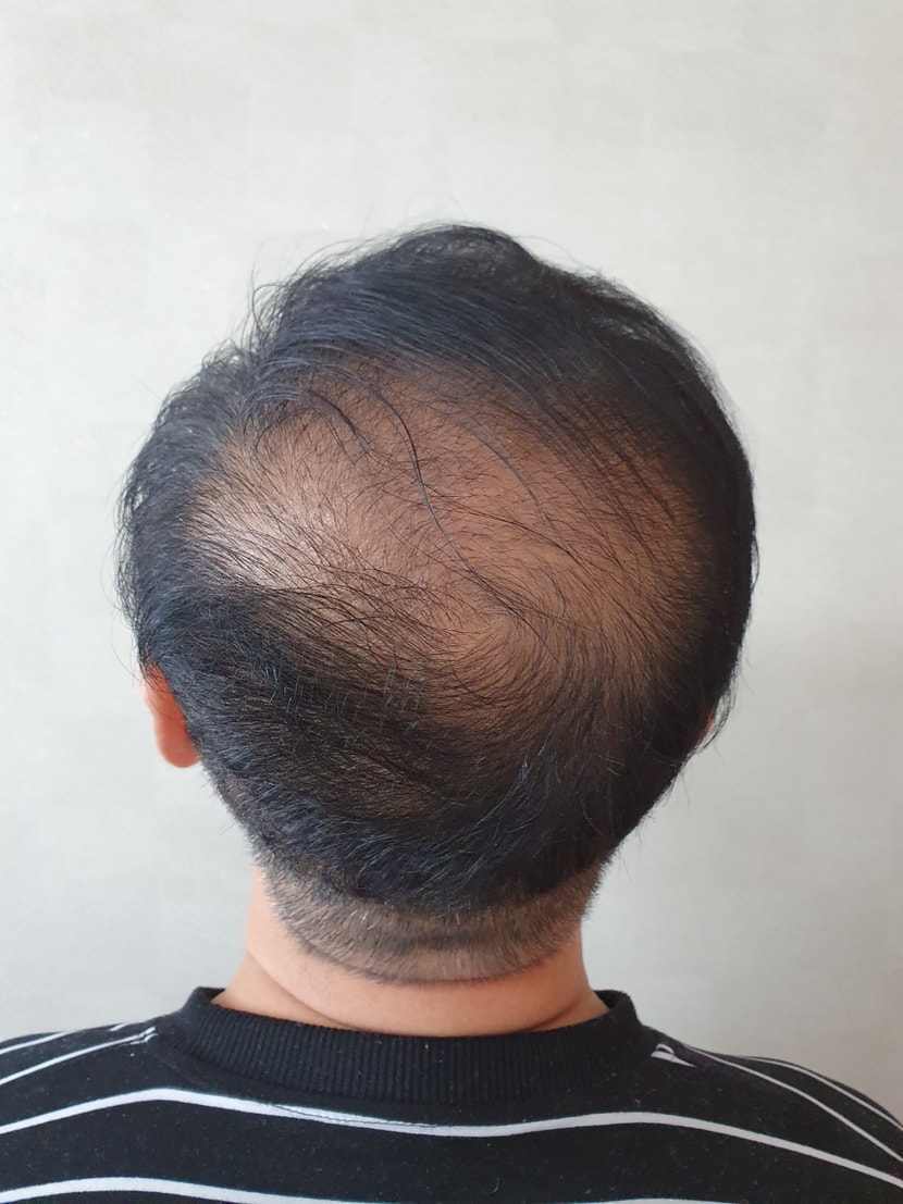 수술 후 정수리네요