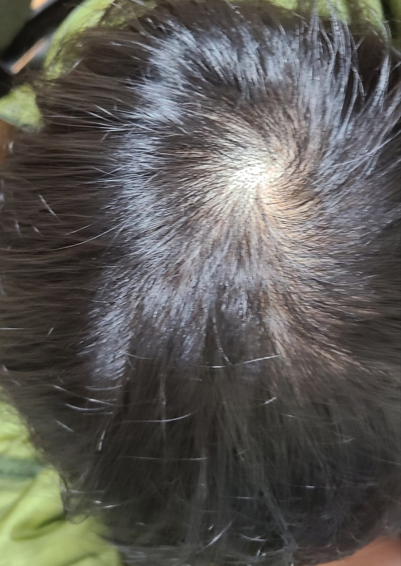 피나 8개월차인데 효과가 점점 떨어지네요