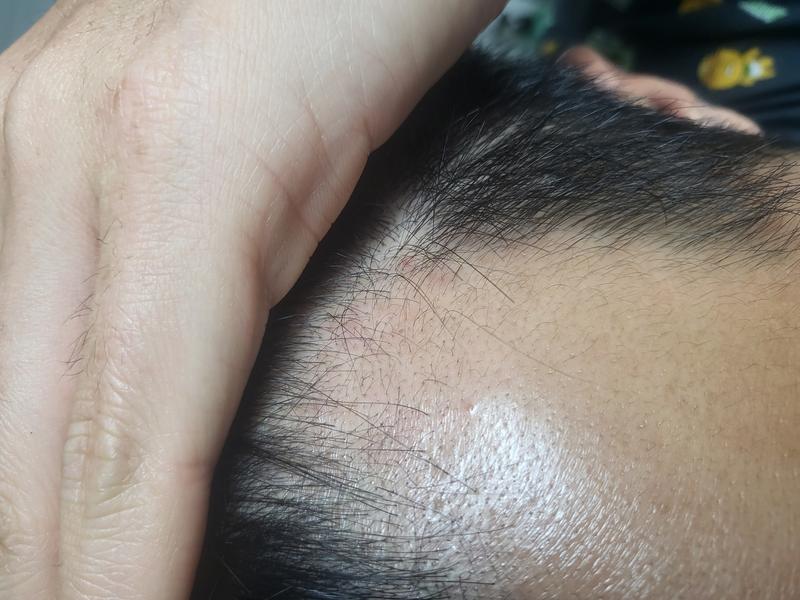 프페12년->핀페,미녹정 50일 경과