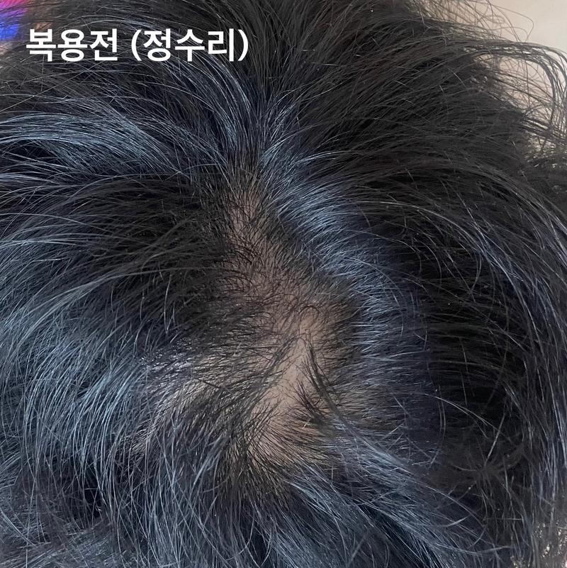 피나스테리드+로게인폼 3개월 사용 변화