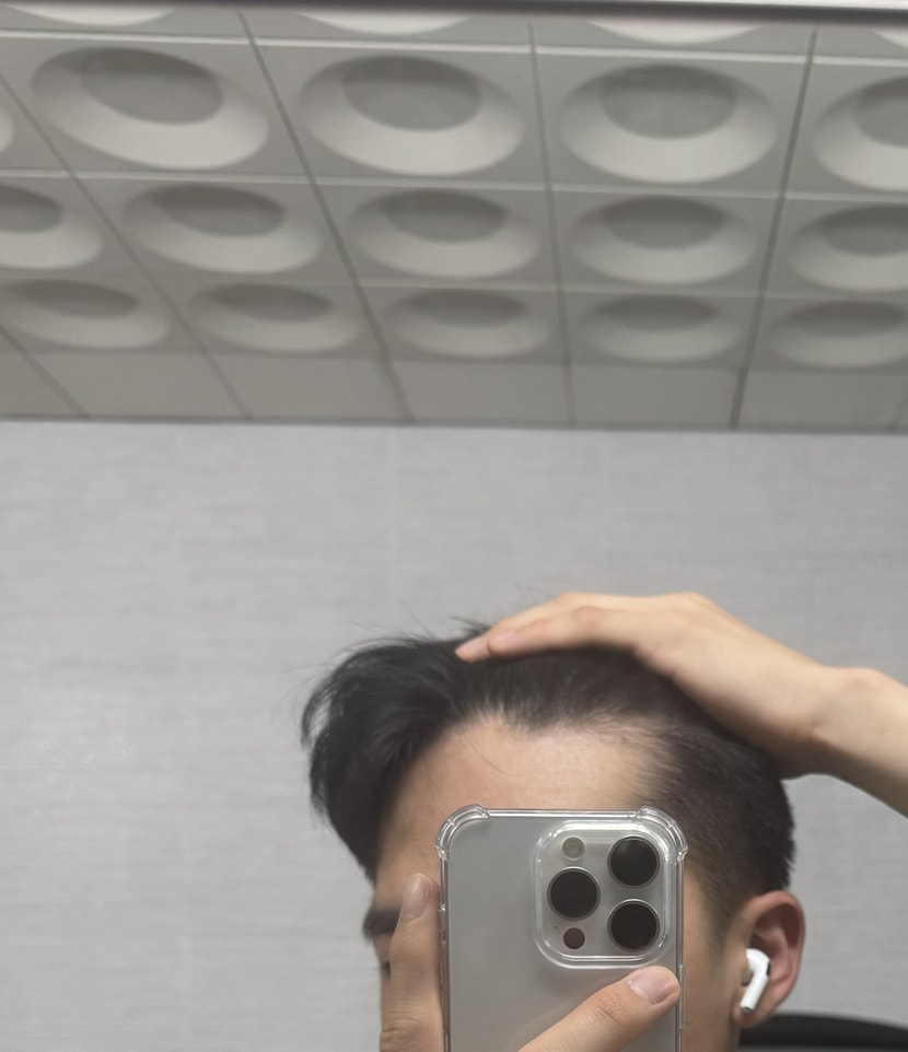 오른쪽 머리 보면 저렇게 비어보이는데 탈모에요?