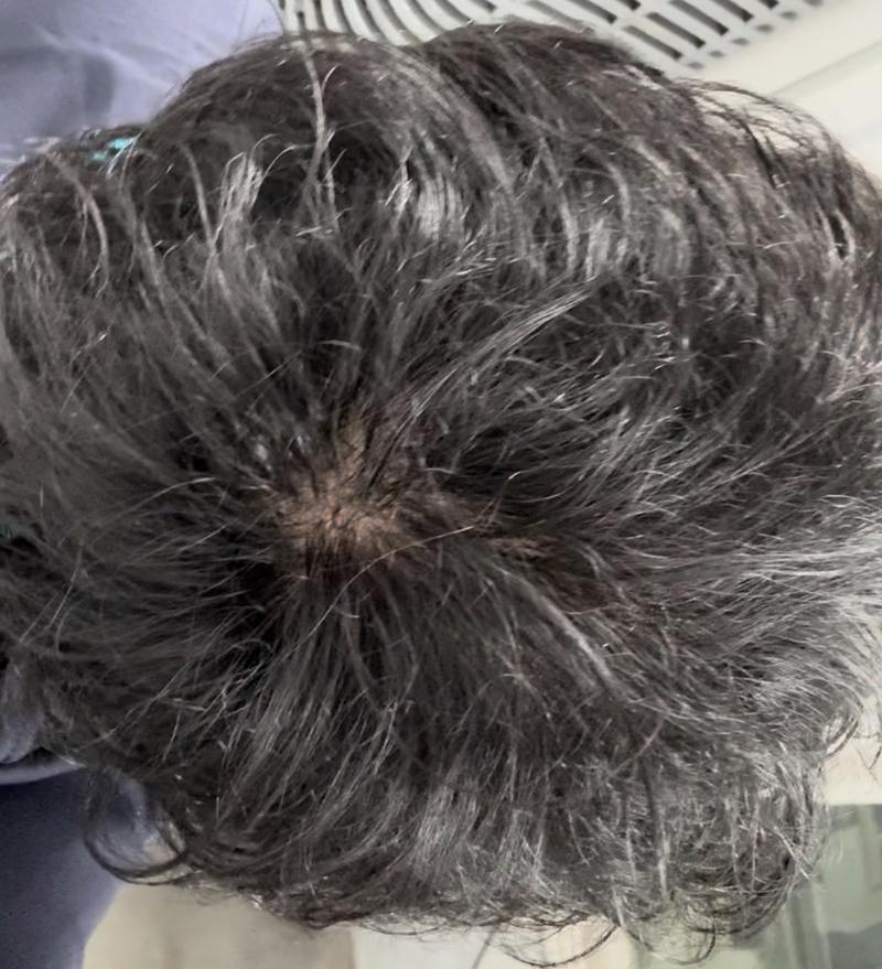 피나3개월차입니다 어때보이시는지 궁금합니다