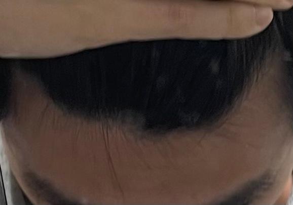 20多岁的人可以烫脱发..?