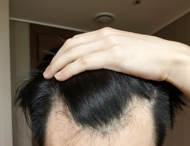 프로페시아 10개월차+모발이식 8개월차 부작용과 변화