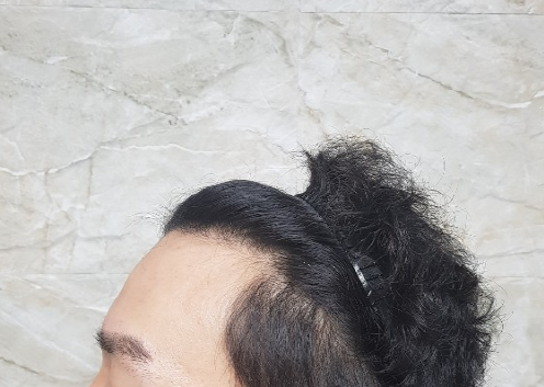 절개모발이식 전