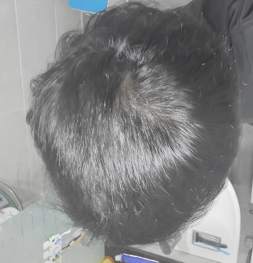 두피 문신 후(오늘)