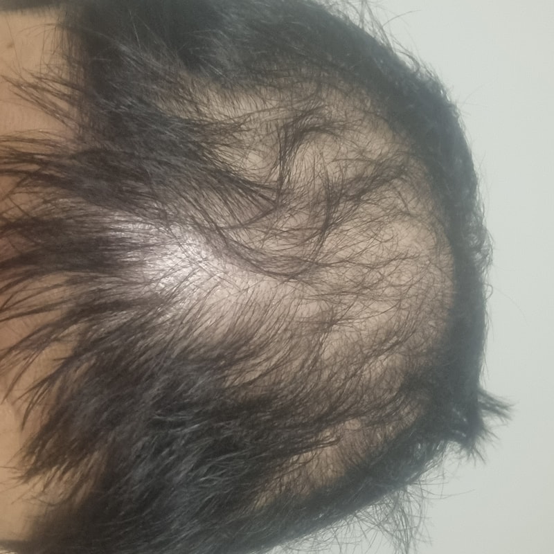 탈모가 심각한가요?