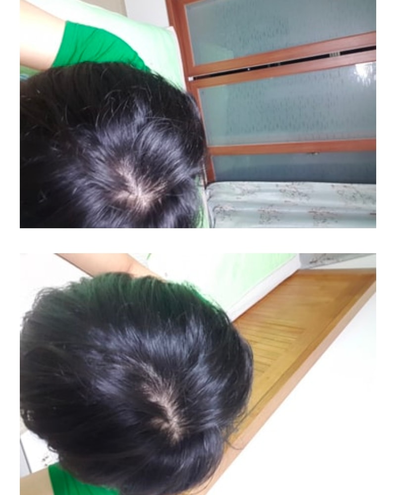 5년전vs현재 탈모진행도 비교