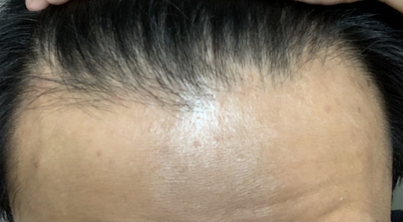 가입하고 처음으로 글 올립니다. m자 탈모