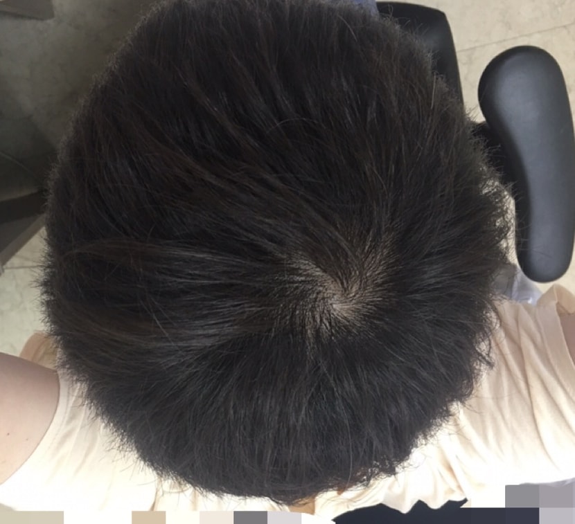 다시 복용 후 많이 호전됨