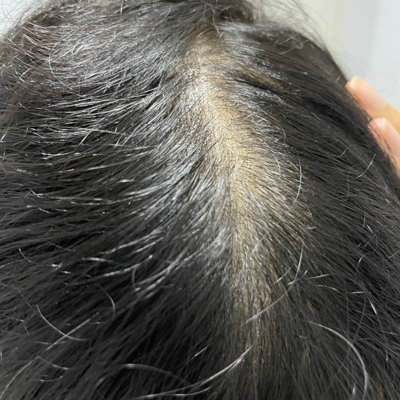 탈모약 부작용 때문에 갈아탔습니다