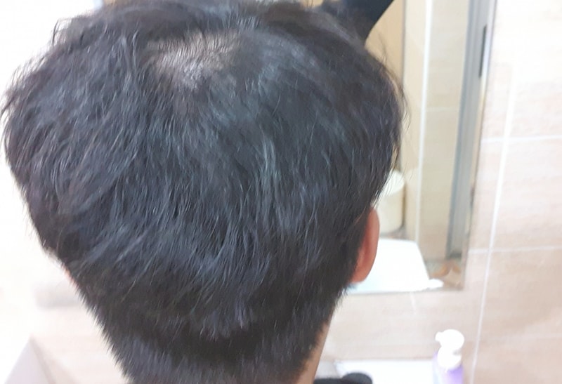 탈모 티 많이나나요?...화장실에서 거울반사시켜 정수리를 봤는데 심한거같아서요ㅠㅠ