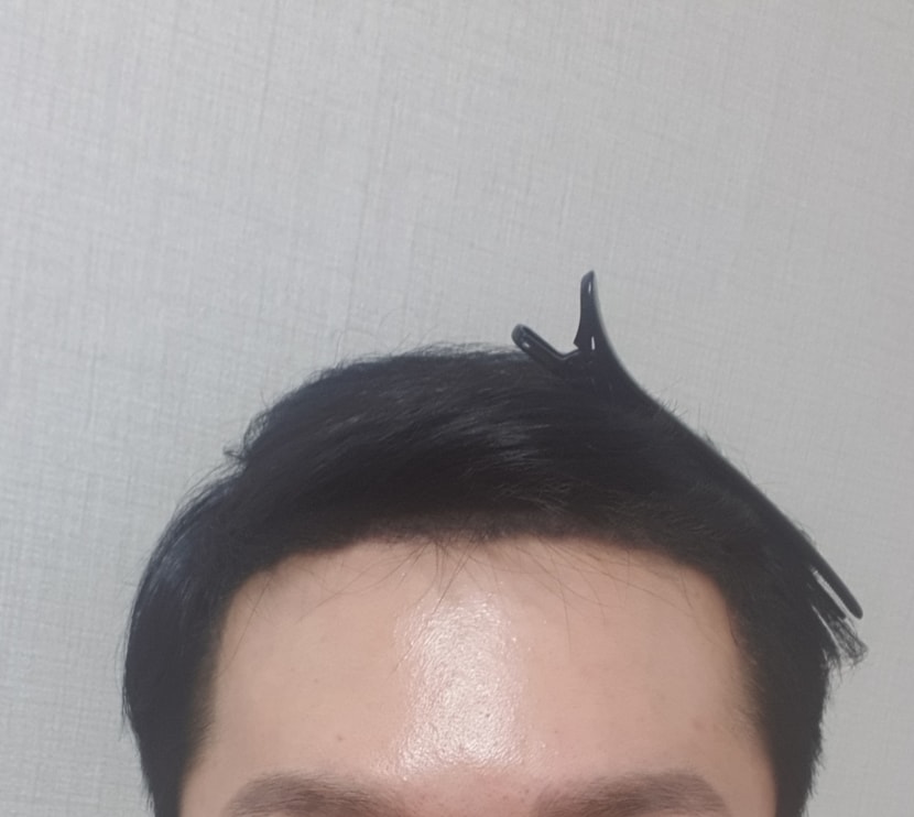 정면 헤어라인입니다. 개인적으로 마음에 듭니다. 너무 좁지도 넓지도 않고 적당하네요!