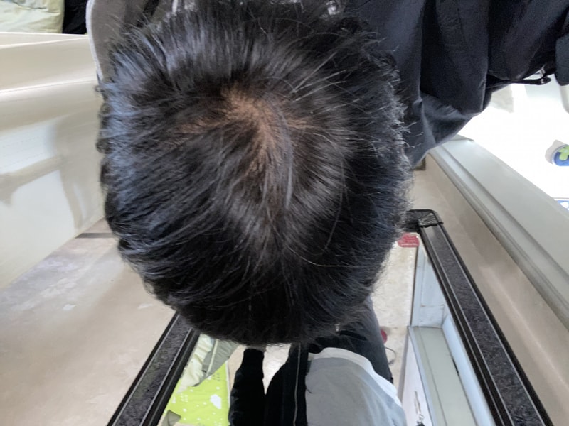 26살 탈모 많이 심한가요?