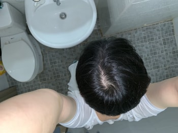 로게인폼 도포 후1