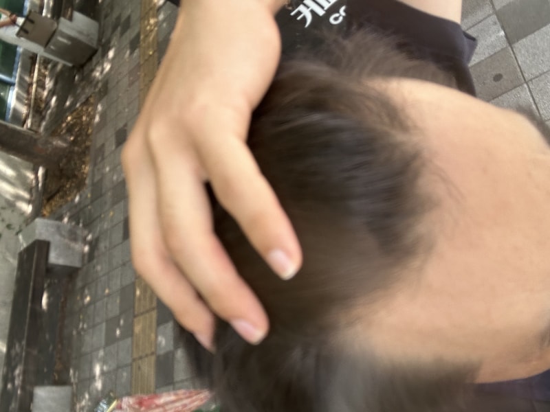 I was diagnosed with hair loss today