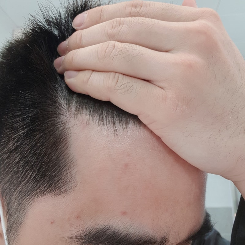 M型脱发开始了吗？