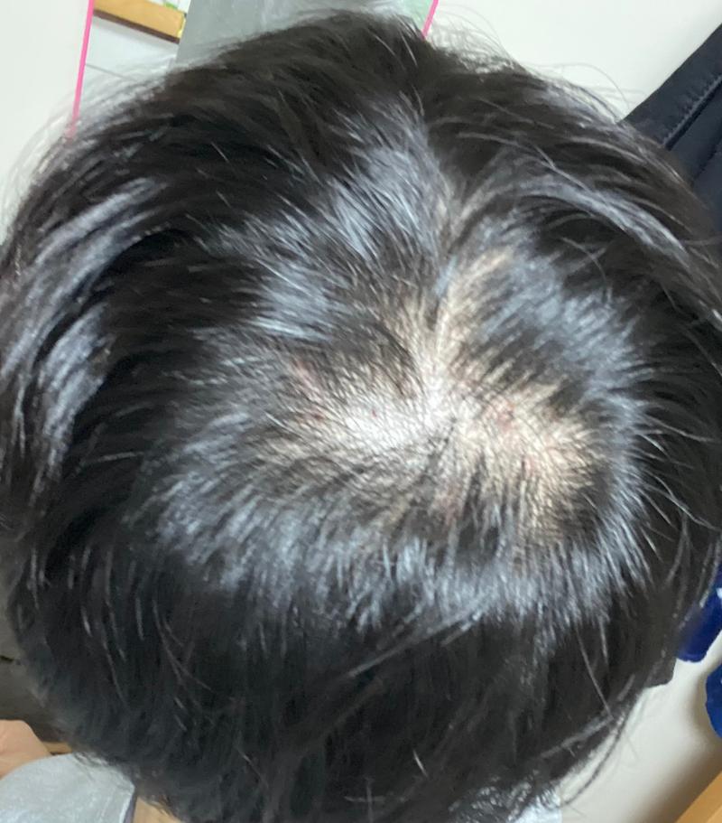 약 갈아타면서 돌고 돌아 미치겠네요.. 그냥 미녹정 먹어야 될까요