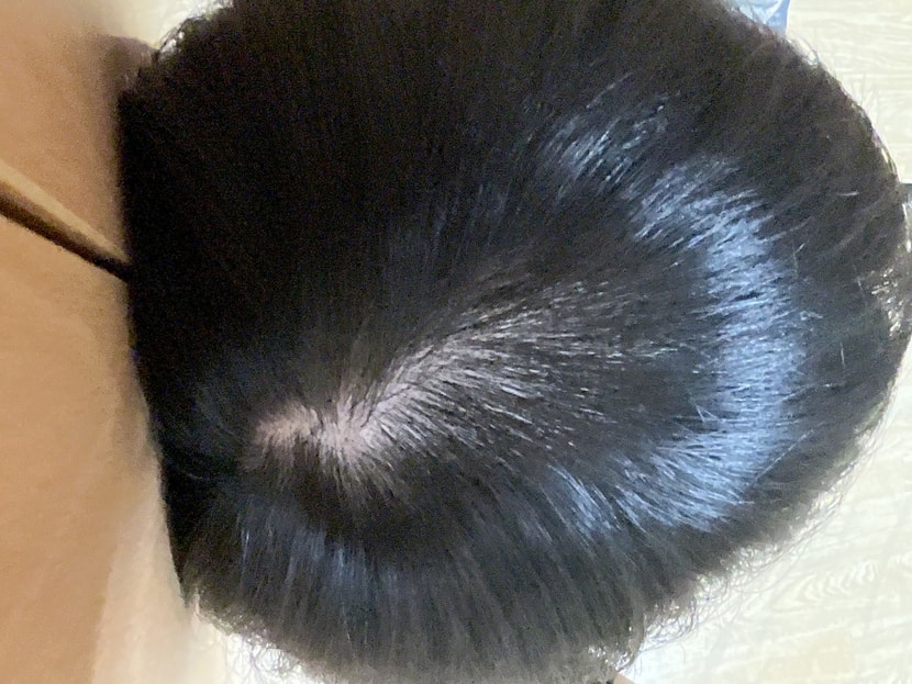 작년 8월 (약 바르기전)