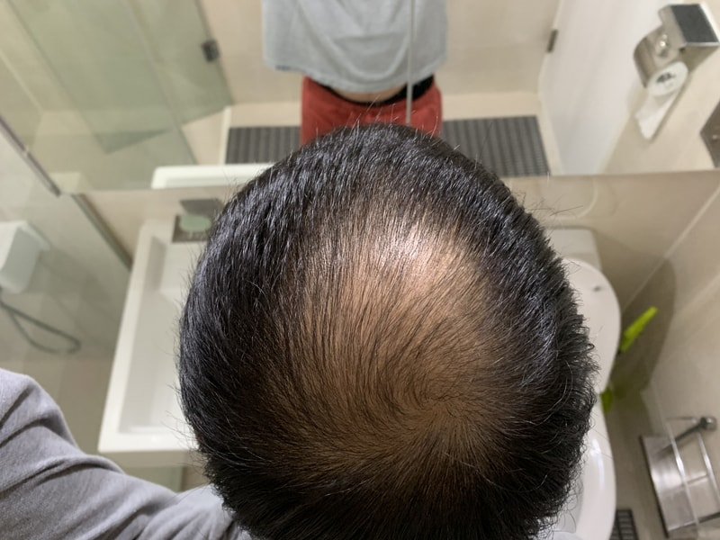 정수리이식 딱2주 밀도 어떤가요