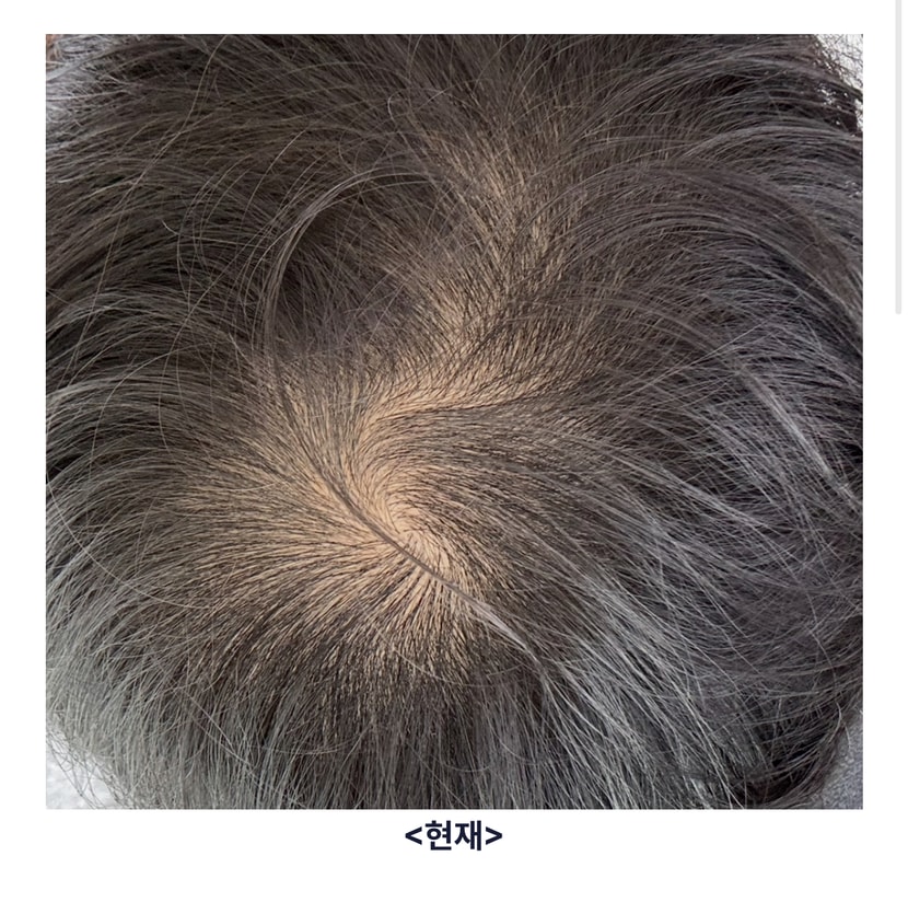 약 복용 한달째 사진입니다.