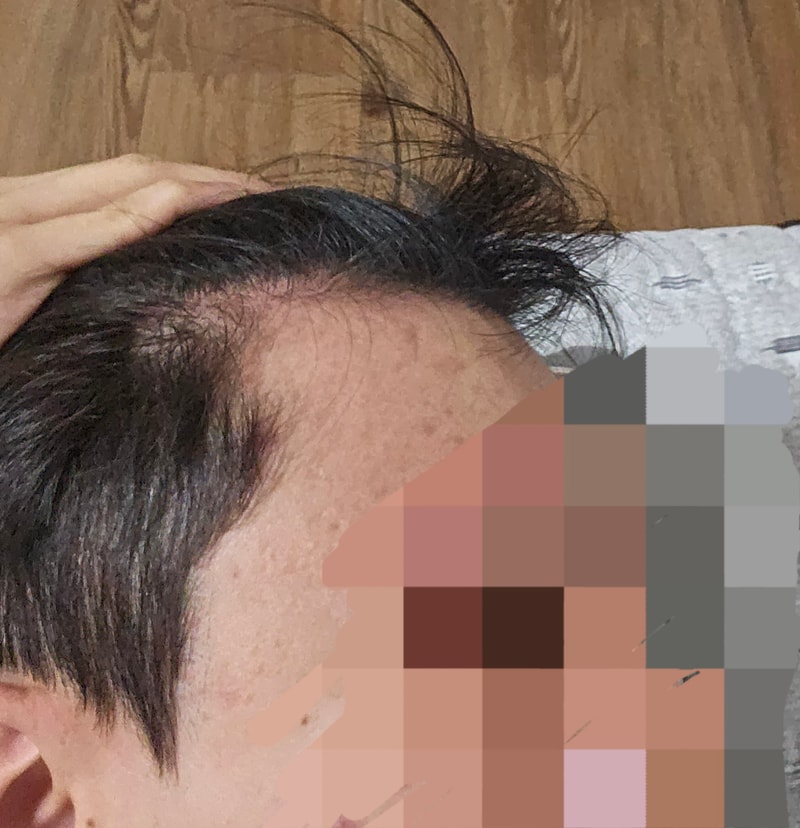 23세입니다 모발이식 언제쯤 하는게 좋을까요?